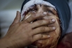 1-е место в категории «События. Одиночная фотография». Идлиб, Сирия, 10 марта 2012 года. Аида приходит в себя от тяжелых ранений, полученных во время обстрела её дома сирийской армией. Её муж и двое детей погибли. 