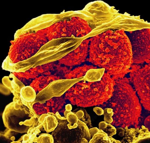 Менингит также может вызывать эта бактерия — Staphylococcus aureus (на снимке — жёлтого цвета).