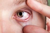 Синдром сухого глаза у кого чаще встречается