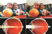 Без лечения катаракты зрение может безвозвратно исчезнуть.