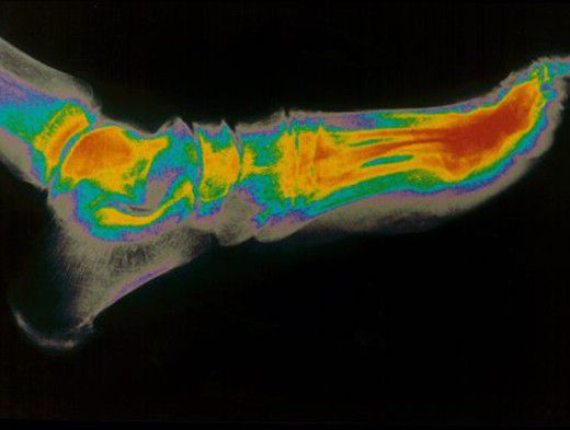 Нужно ли лечить подагру? | Вопрос-Ответ | Аргументы и Факты