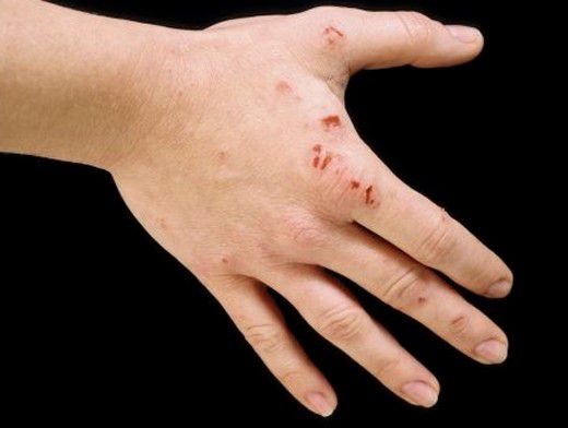Кровоизлияния в кожу