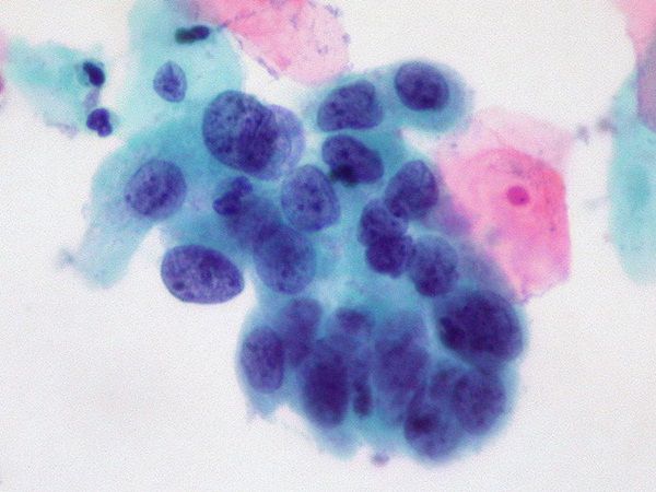 Плоскоклеточный Рак Кожи Головы Фото