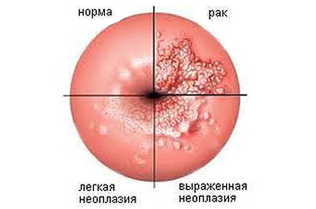 Лечение эрозии шейки матки в клинике Семейный доктор в Москве