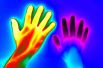 Тепловое изображение рук двух людей – здорового и человека с синдромом Рейно.