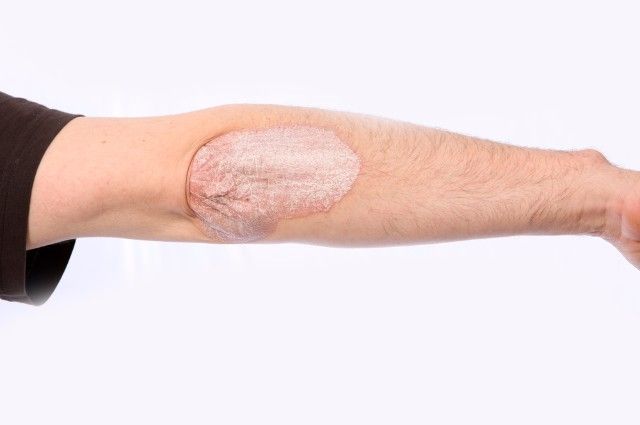 Белые пятна на коже – диагностика и лечение