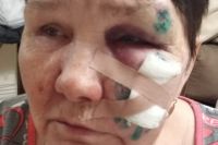 69-летняя Надежда Марина получила травму лица и груди. 