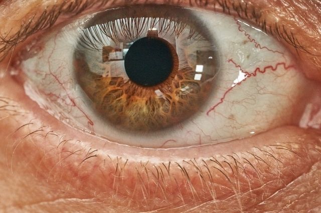 В Тюмени врачи вернули зрение двум пациентам, у которых была редкая болезнь