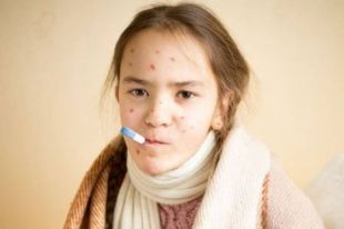 С 10 по 16 июня в Украине корью заболели 967 человек.