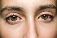 Жить здорово о синдроме сухого глаза