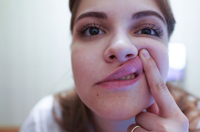 Как избавиться от стоматита? | Здоровая жизнь | Здоровье | Аргументы и ...