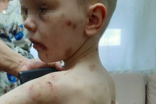 Избитый матерью мальчик.