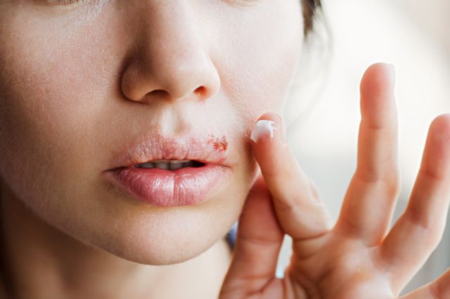 Какие средства помогут вылечить потрескавшиеся губы? | Секреты красоты |  Здоровье | Аргументы и Факты