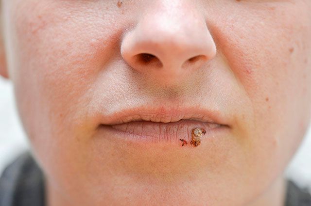 Пузырьки на губах – не простуда, а опасная болезнь