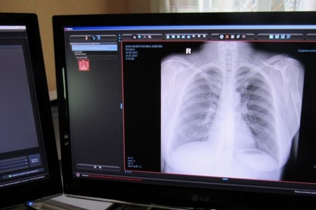 Компьютерная томография более информативна при диагностике воспаления легких.