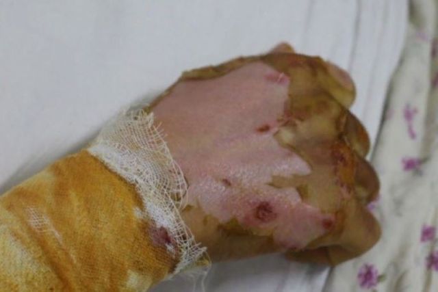 Дагестанские врачи спасли подростка с ожогами 45% тела из Ингушетии