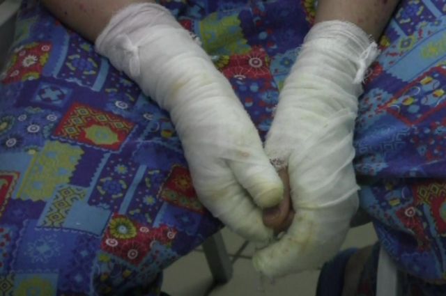 Один из пострадавших на пожаре в горбольнице Пскова помещён в реанимацию