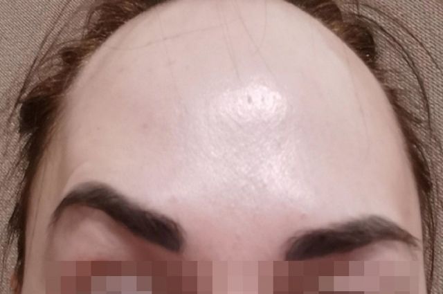 У девушки перекосило лицо после визита к косметологу в Новосибирске