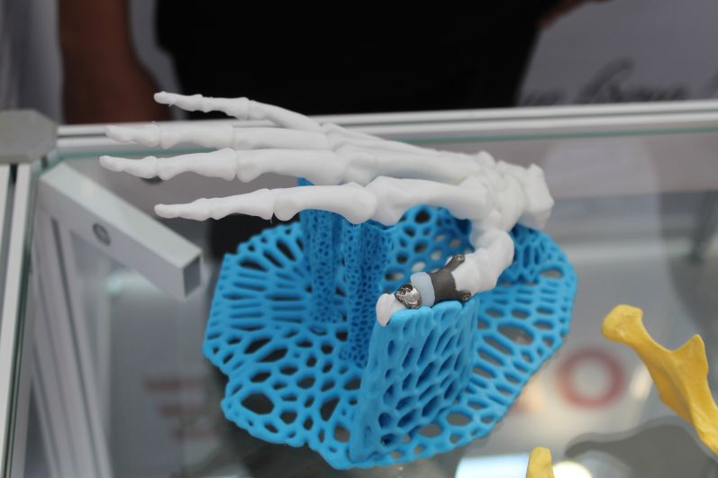 Детали для имплантов сделали на 3Д-принтере.