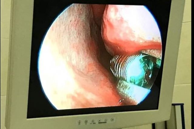 Зубной имплант извлек из носа пациента нижегородский ЛОР-врач Белозёров