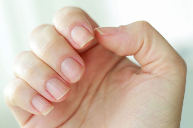 Белые пятна на ногтях - откуда появляются и как избавиться