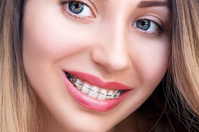 Сапфировые брекеты более хрупкие, чем металлические, но почти незаметны на зубах. Взрослые люди чаще выбирают их.