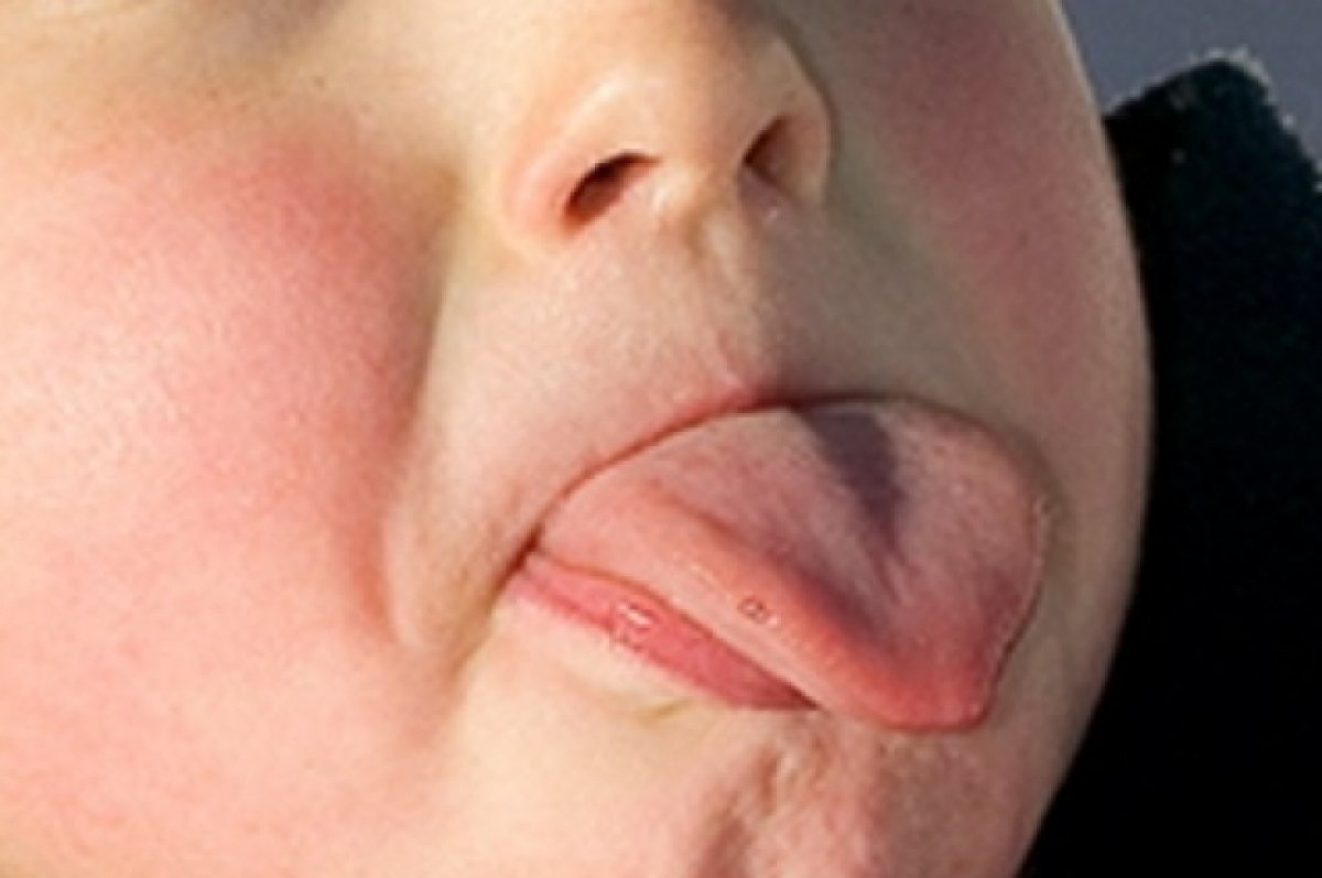 Челябинские врачи рассказали, что делать, если прилип языком к железу на морозе