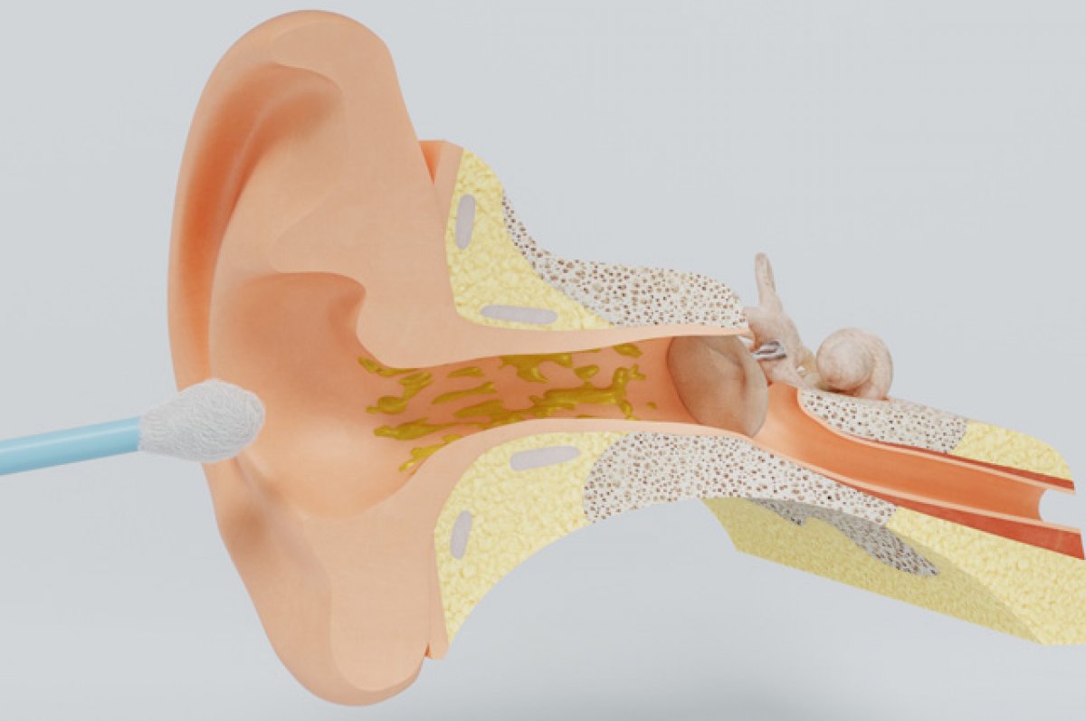 Выделения из уха: как лечить оторею