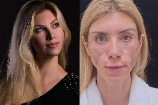 Фото Юлии до и после операции. 