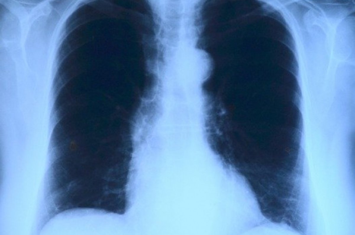 Рентген легких пневмония covid19