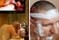40-летний житель Новосибирска Михаил Радуга просверлил себе череп дрелью и вставил в мозг имплант.