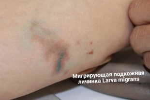 Гельминтоз - причины появления, симптомы заболевания, диагностика и способы лечения