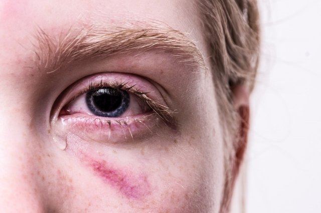 Во время хоккейного матча шайба влетела прямо в глаз болельщице. 