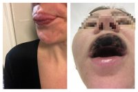 Фото пострадавших от пластики - слева губа "как вареник", справа - некроз губы.
