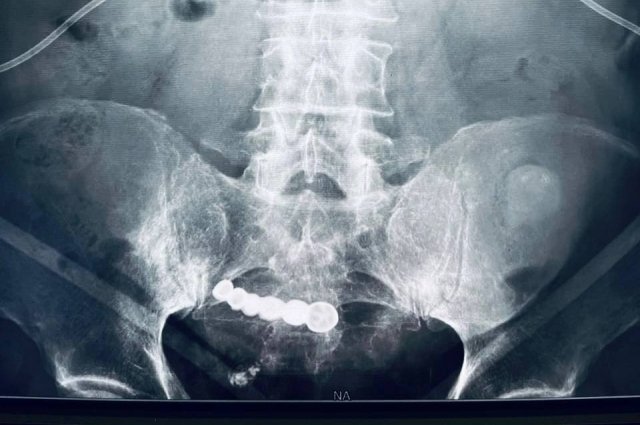 На рентгеновском снимке врачи обнаружили нечто невероятное - «зубы»пациента. 