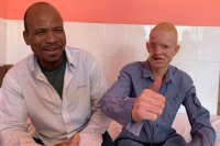 Пациент-альбинос из Африки Хадим вместе со своим отцом.