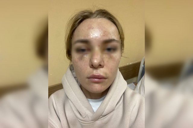 Фото пострадавшей петербурженки после нападения.