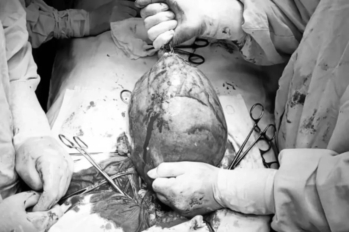 На Алтае у женщины удалили опухоль, размером с 7 месяц беременности