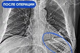 Хирурги через минимальные проколы вернули лёгкое в плевральную полость и устранили грыжевой дефект.