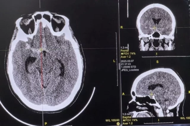 Так называемый «тихий» или «немой» инсульт часто протекает незаметно для самого человека.