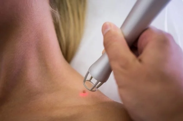 Продавцы лазерных аппаратов на маркетплейсах позиционируют их как эффективный и безопасный прибор для удаления родинок.