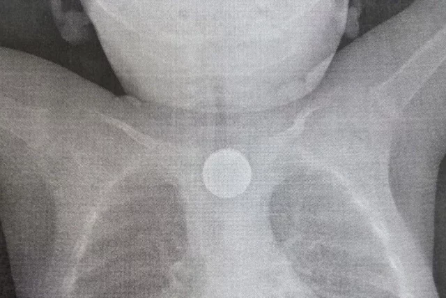 Бригада врачей с помощью эндоскопии вытащила из пищевода ребёнка двухрублёвую монету и дисковую литиевую батарейку.