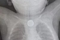 Бригада врачей с помощью эндоскопии вытащила из пищевода ребёнка двухрублёвую монету и дисковую литиевую батарейку.