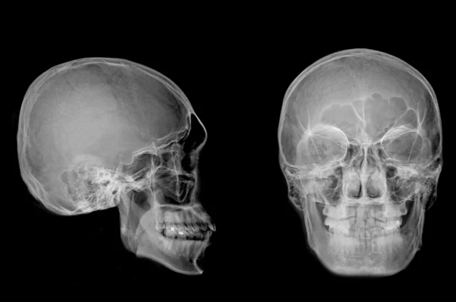 Краниопластика широко востребована не только у детей, но и среди совершеннолетних пациентов.