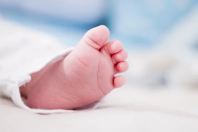 Плод погиб из-за гипоксии на позднем сроке беременности.