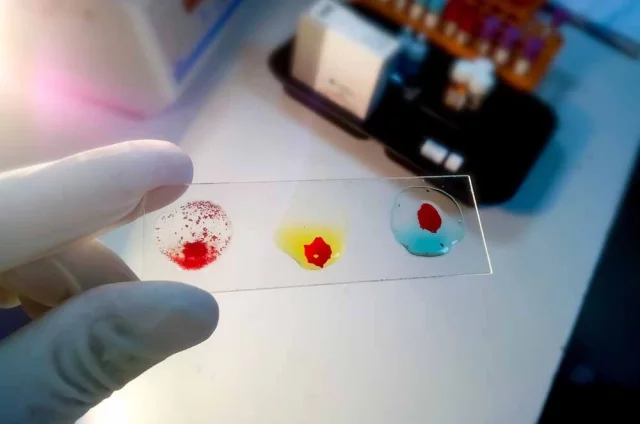 Ученые сделали открытие: переливание молодой крови защищает от болезни Альцгеймера, а старой — ускоряет ее развитие.