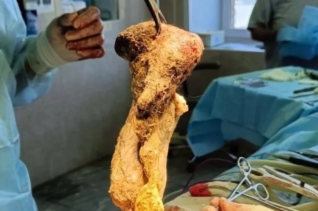 Огромный шар из волос достали из желудка девочки. 