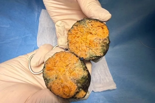 Фитобезоар из хурмы