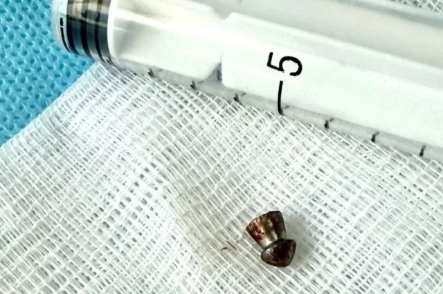 Извлеченная пуля едва не повредила лицевой нерв мальчику