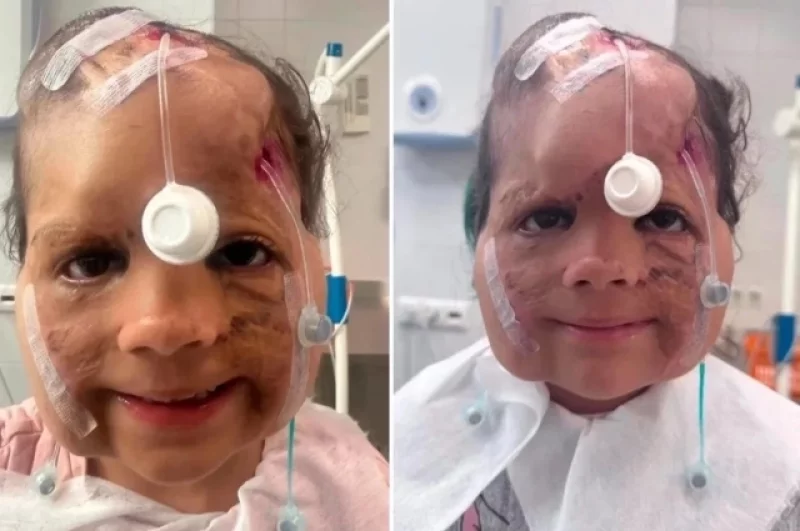 В 2026-м девочке установили тканевые экспандеры – специальные баллончики-расширители.